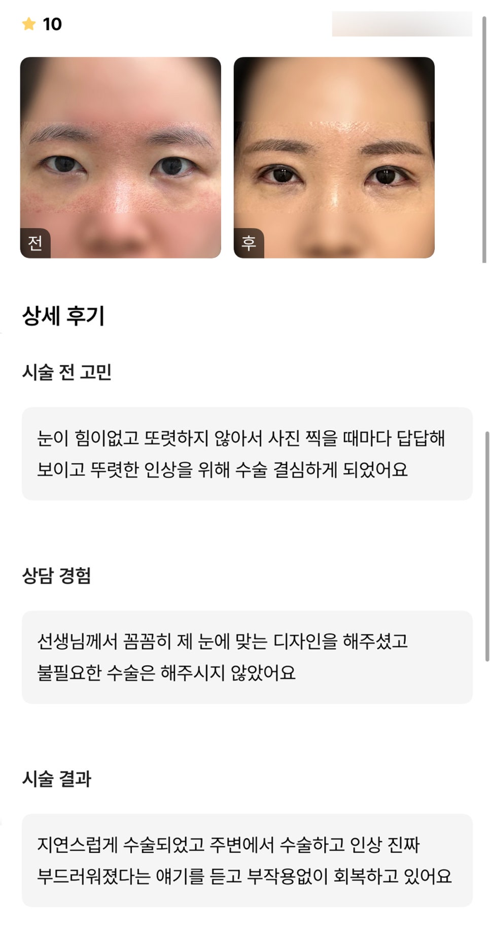 눈성형 후기."인상이 부드러워졌다는 말을 많이 듣고있어요!" 관련 이미지 1