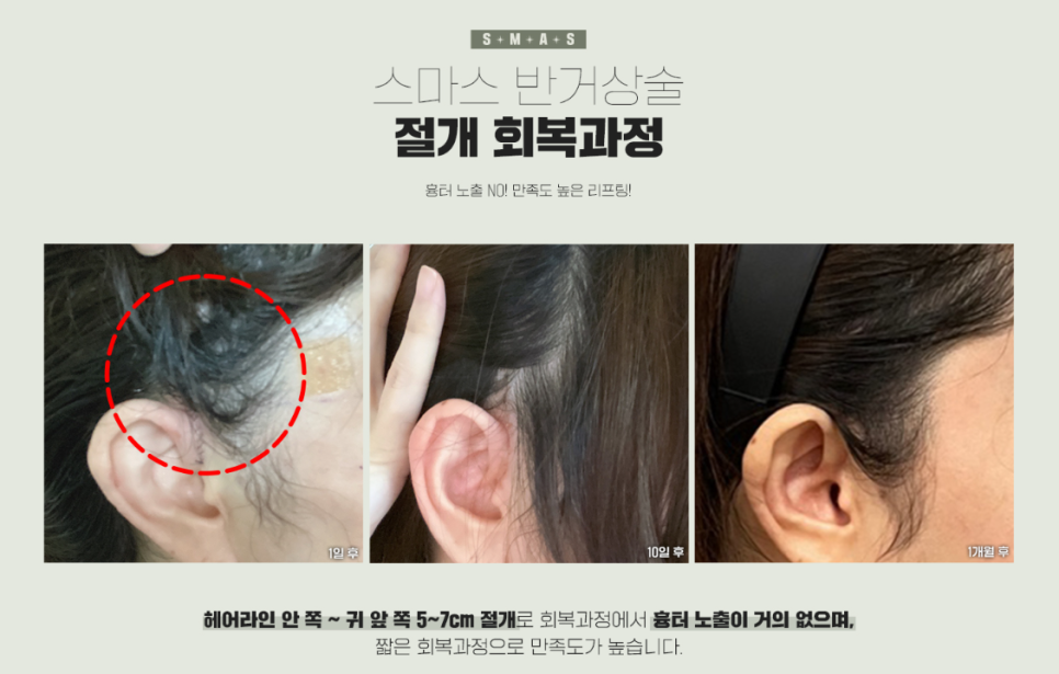 반거상, 안면거상은 부담스러웠다면 주목! 관련 이미지 8
