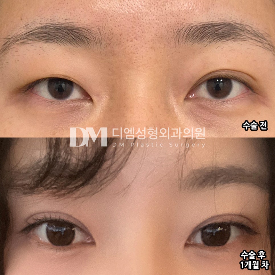 디엠 눈재수술 후기, &ldquo;라인 자체도 마음에 들고 붓기도 빨리 빠졌어요!&rdquo; 관련 이미지 2