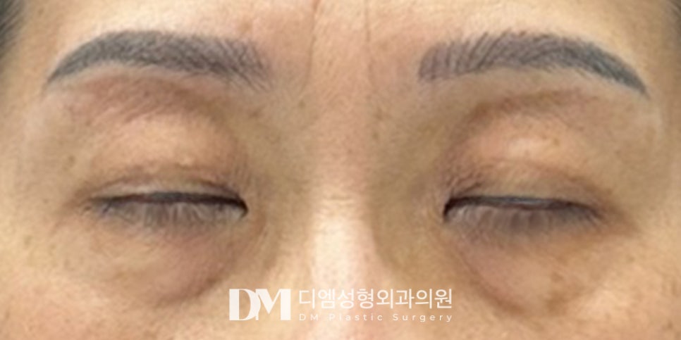 하안검, 미적 개선과 기능 회복까지 동시에! 관련 이미지 7