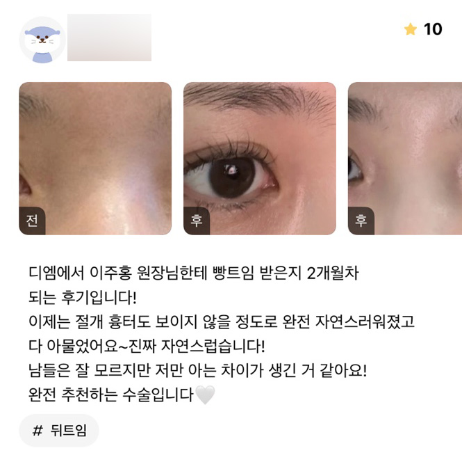 Canthoplasty Review. “Others may not notice, but I feel like there’s a difference only I know about!” image 1