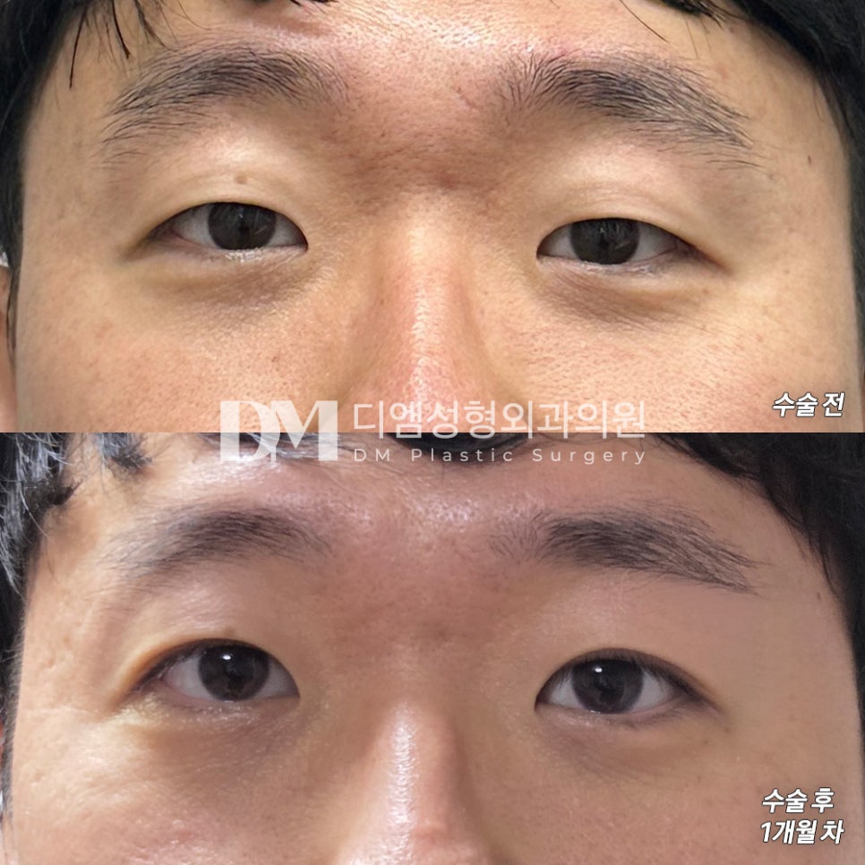 Eyelid Surgery Review. “It was so natural that no one knew I had double eyelid surgery!” image 2