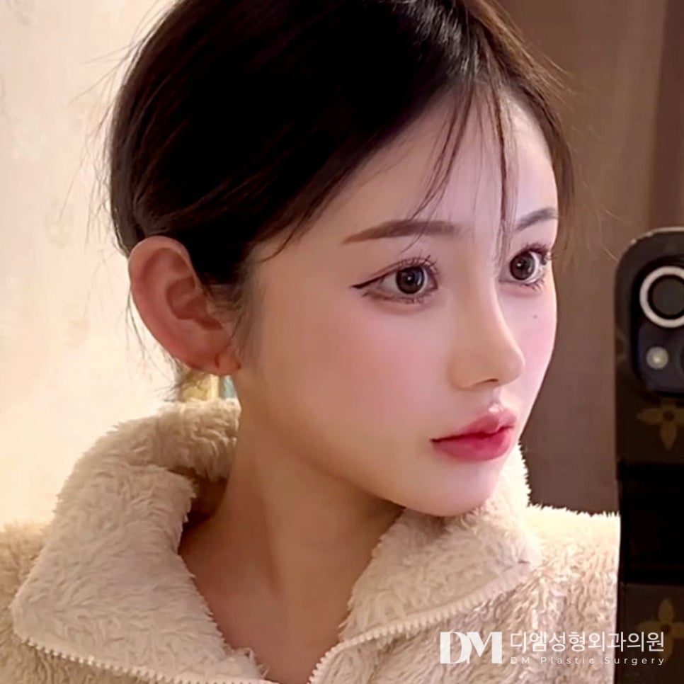 화살코 성형, 컴플렉스 극복은 물론 자신감 충전까지 ! 관련 이미지 10
