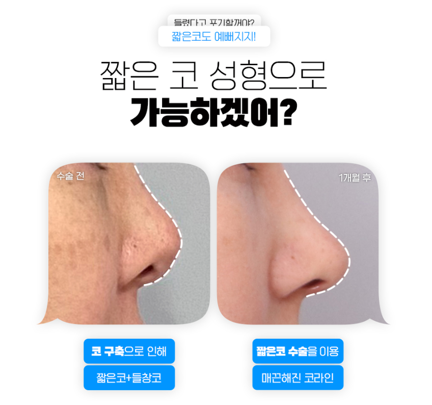 짧은코성형, 무조건 늘리고 높이기 보다 자연스럽게 맞춤형으로! 관련 이미지 3
