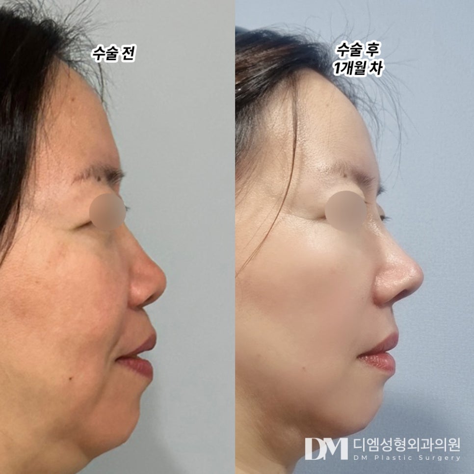 코성형 후기."매일 저도 모르게 거울을 봅니다 !" 관련 이미지 2