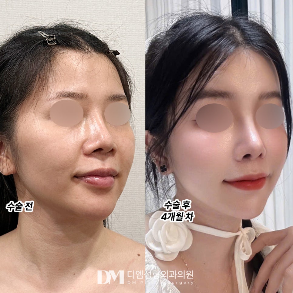 The Secret to Looking Younger: Facial Fat Grafting image 6