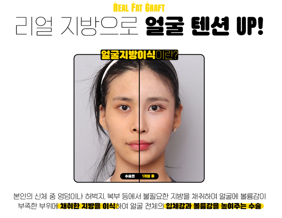 Facial Fat Grafting: Adding Natural Volume to the Face image 2