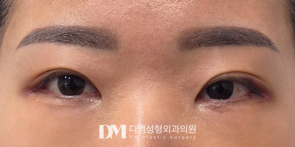 눈밑지방재배치, 피곤한 인상 볼록한 눈밑 개선 효과! 관련 이미지 7