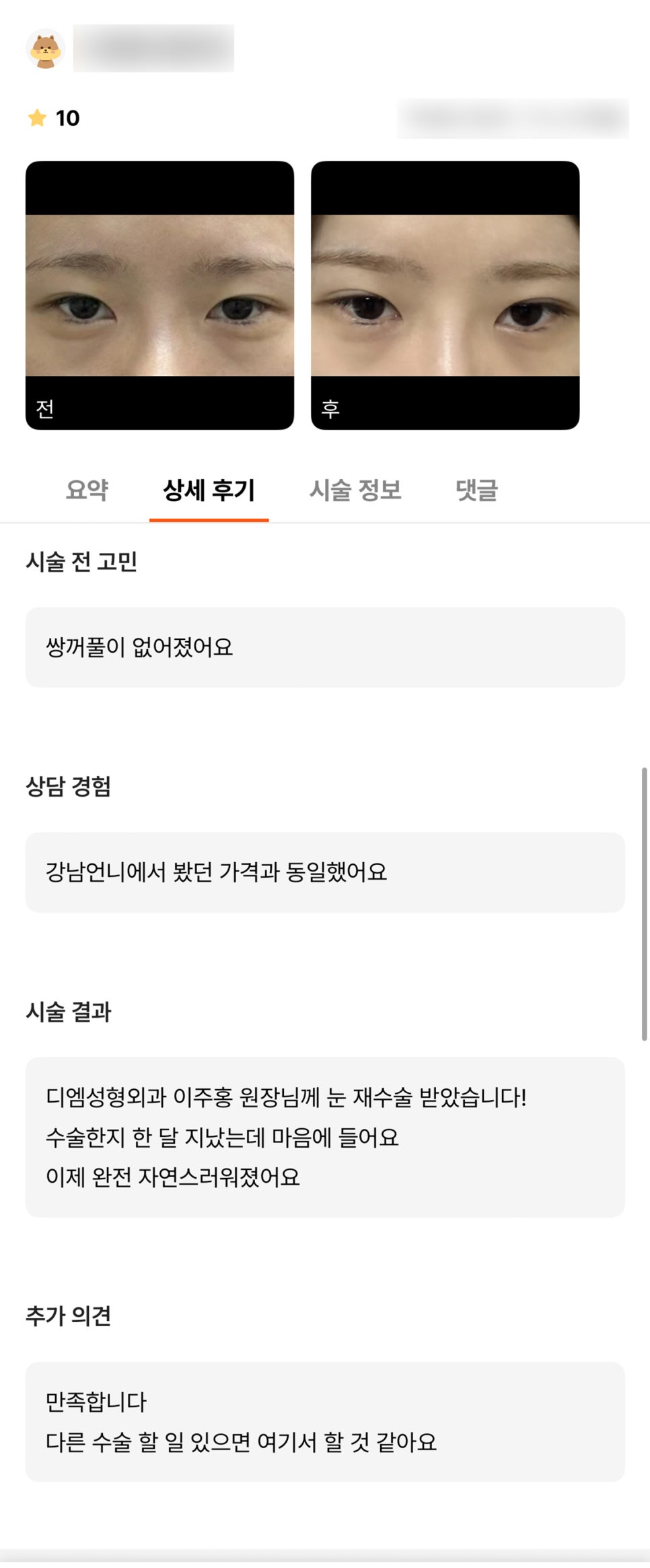 눈재수술 후기."1개월 차 인데 완전 자연스러워 졌어요!" 관련 이미지 1