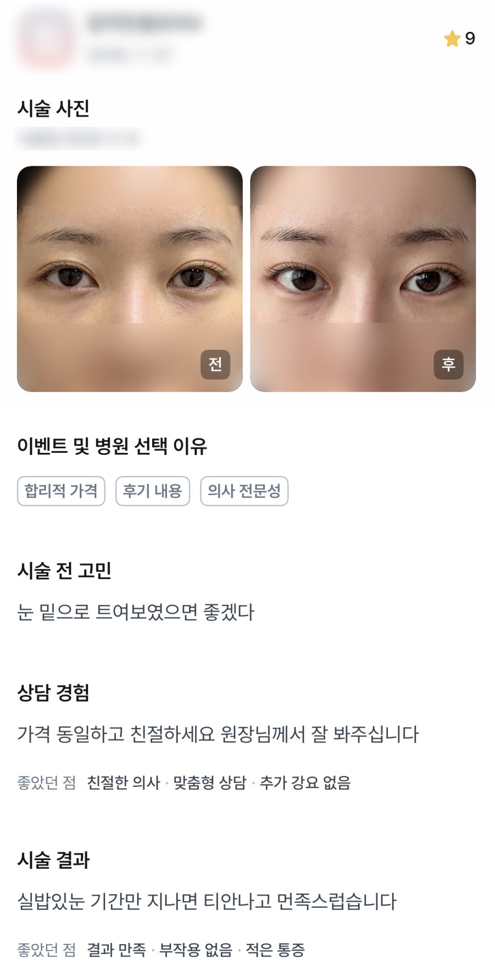 DM Lateral and Lower Canthoplasty Surgery Review, “I’m satisfied because it doesn’t look noticeable!” image 1