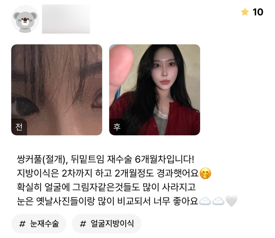 Eye Surgery Review: “I’m So Happy That I Can Really Compare Them with My Old Photos” image 1