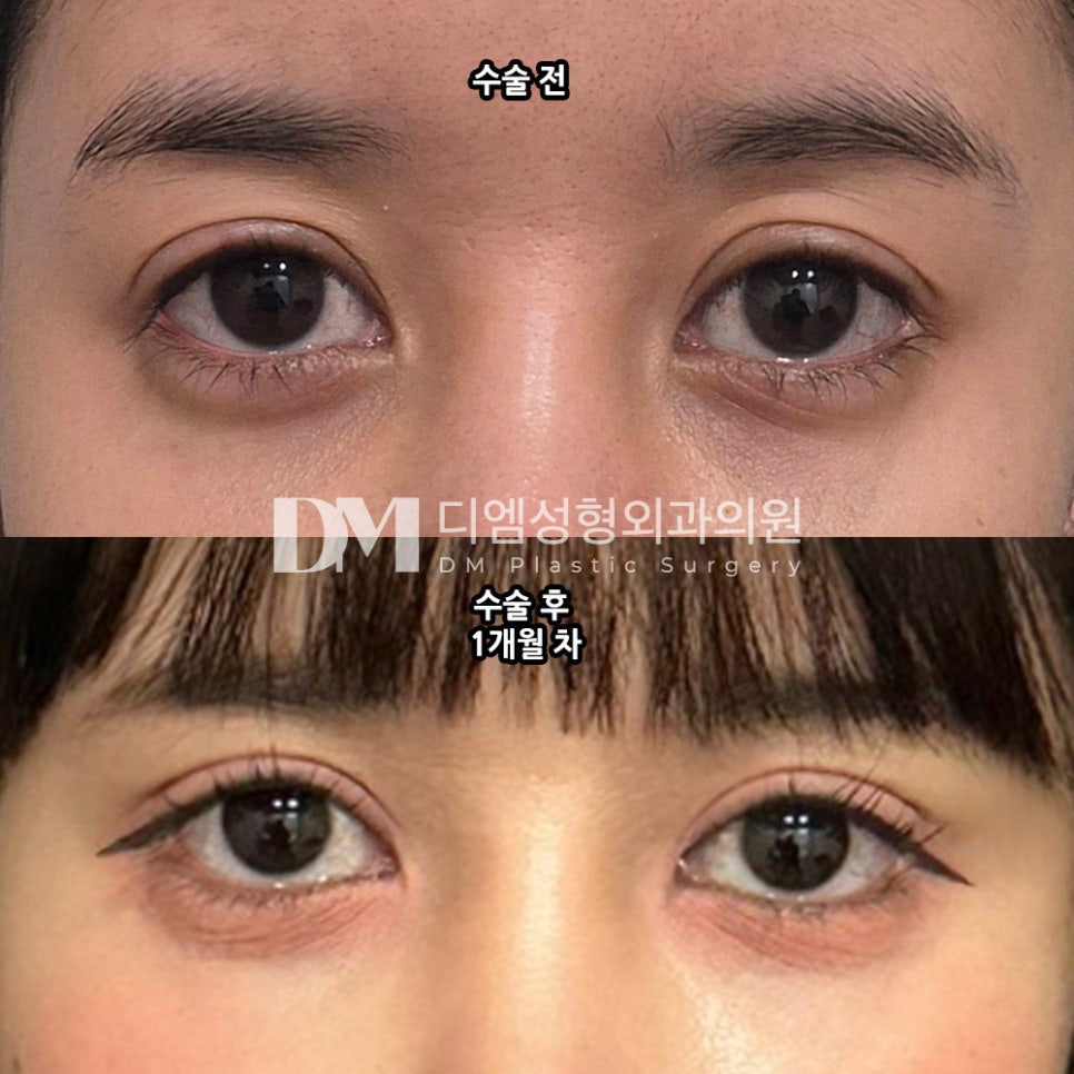 Revision Eyelid Surgery Review: “I’m Looking Forward to Looking More Natural from Here On!” image 2