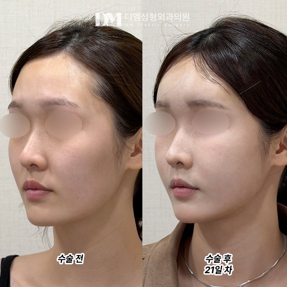 DM Facial Fat Grafting Before-and-After Photos: What’s the Secret to Natural Results Without Overdoing It? image 3