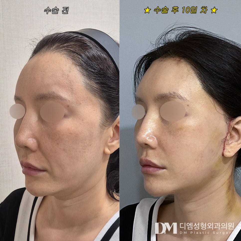 Facelift Review. "So satisfied! I feel like I’ve been reborn!" image 2