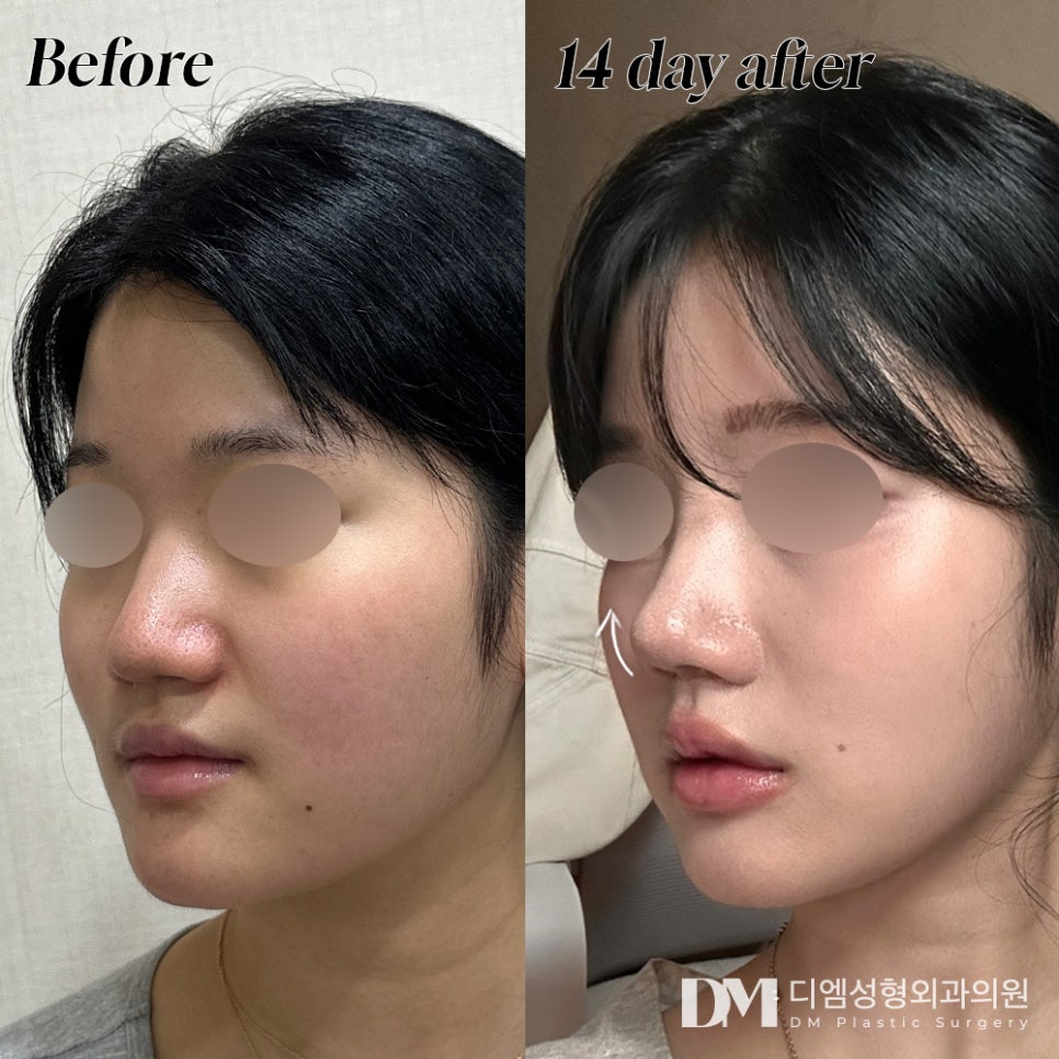 코재수술 , 원인 파악부터 체계적인 플랜까지 ! 관련 이미지 10