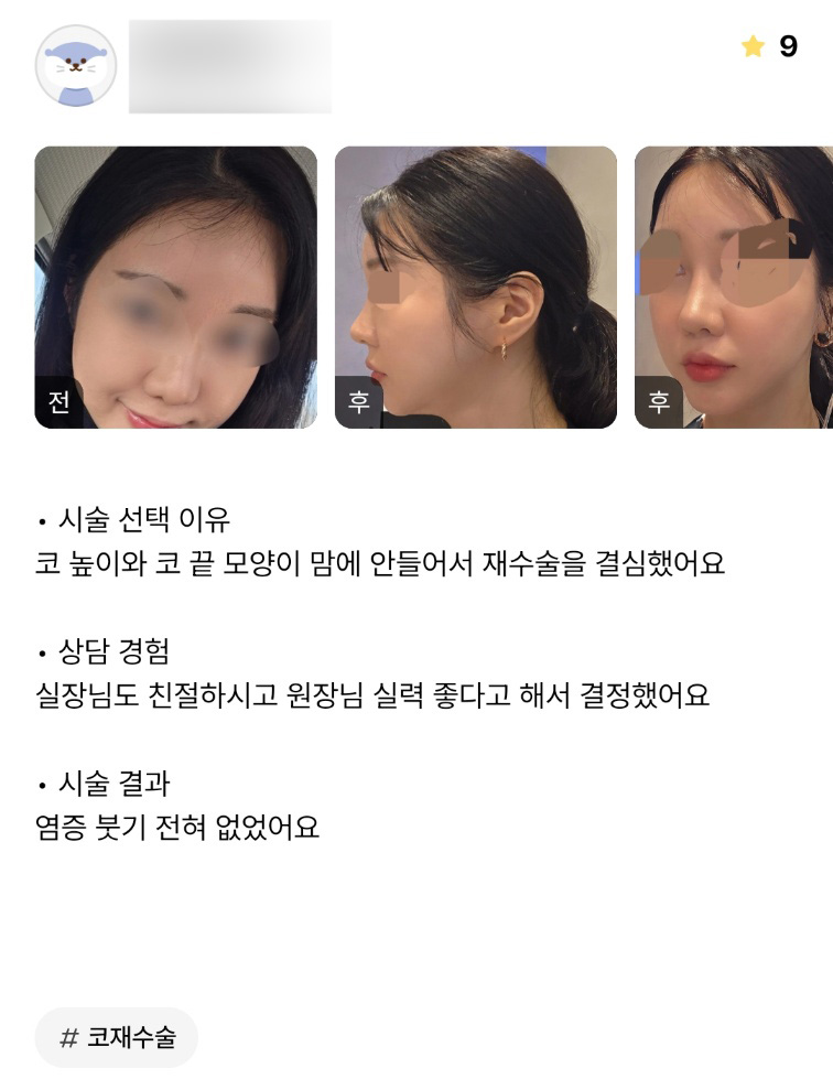 코성형 후기."염증, 붓기 전혀 없었어요!" 관련 이미지 1