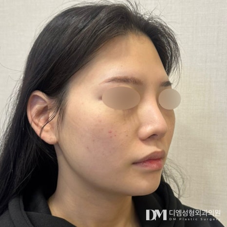 얼굴지방이식 후기."컴플렉스가 개선되어 아주 만족합니다!" 관련 이미지 2