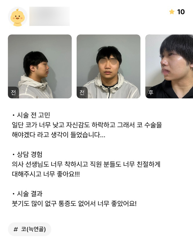 코성형 후기."붓기도 없고 통증도 없어서 너무 좋아요 !!!" 관련 이미지 1