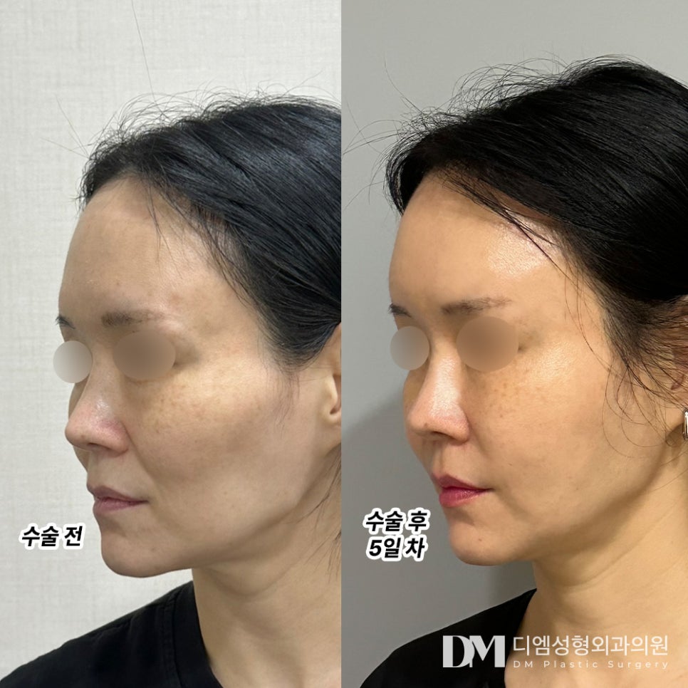 얼굴지방이식, 꺼진 부위에 볼륨과 생기를 관련 이미지 6