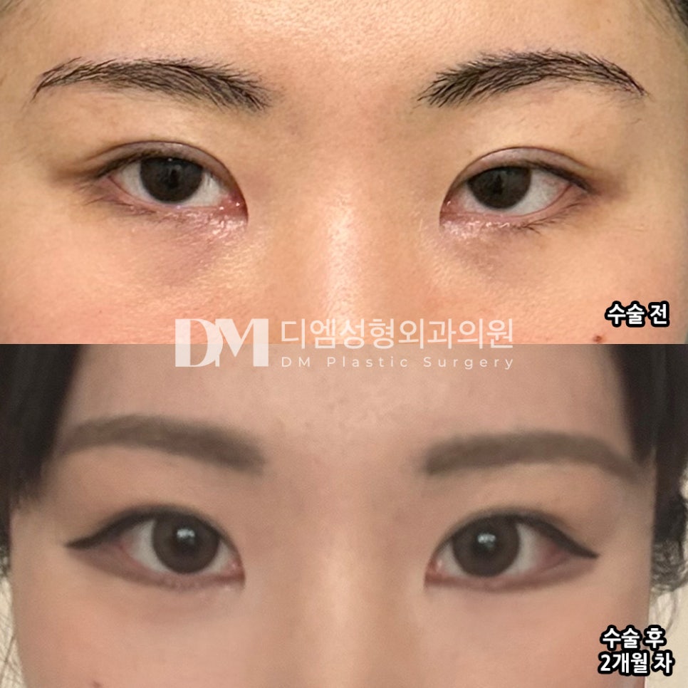 Bbangttim Review. "They were kind, and the recovery was fast, which I liked!" image 2