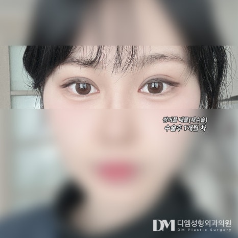 눈재수술 후기."원하는 라인 나와서 너무 만족스럽습니다!" 관련 이미지 3