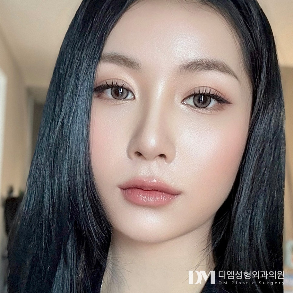 Double Eyelid Surgery: Which Line Suits My Eyes? image 1