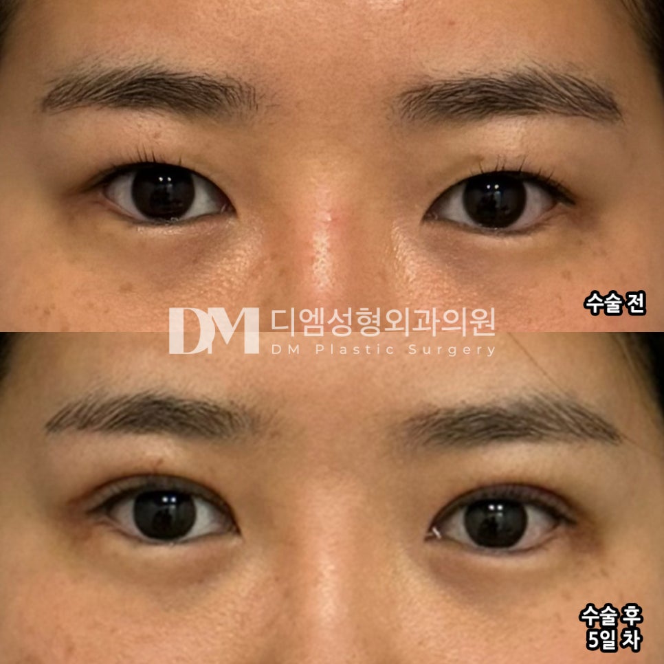 Double-Eyelid Surgery Review: “I Absolutely Love the Double-Eyelid Line!” image 2