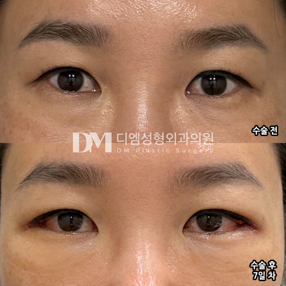 Back Canthoplasty Review. “My First Eye Surgery, and I’m Satisfied with the Back Canthoplasty” image 2