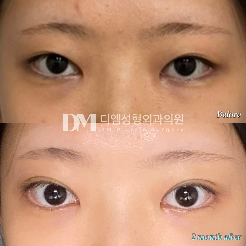 눈재수술 후기."최대한 니즈를 반영해주셨고 자연스러워서 좋아요!" 관련 이미지 2