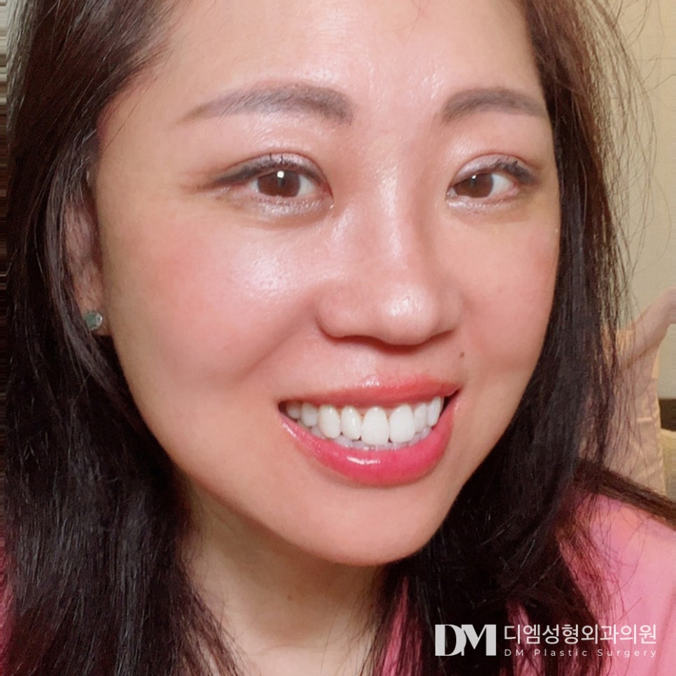 처져 무너진 얼굴형, 안면거상으로 매끈하게 개선하자 ! 관련 이미지 1