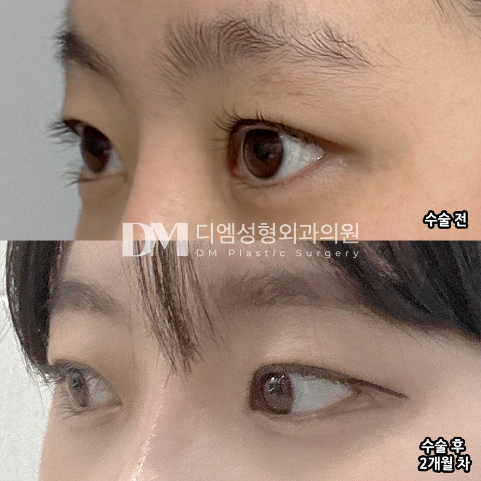 DM Lateral and Lower Canthoplasty Surgery Review, “I’m Satisfied with the Results Because My Eyes Look Wider Horizontally!” image 3