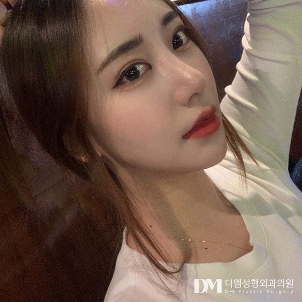 디엠 뒤밑트임 전후사진, 크고 시원한 눈매의 비결은? 관련 이미지 3