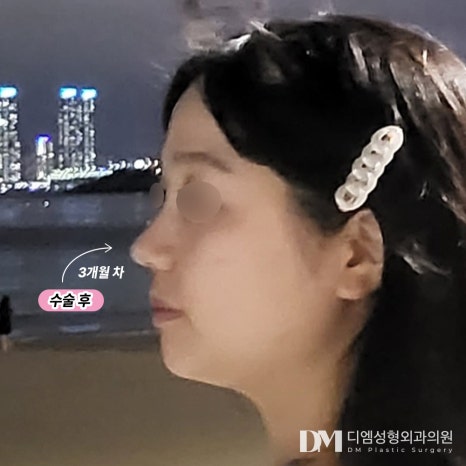 동양인에 흔한 짧은코 수술방법과 주의해야 할 점은? 관련 이미지 9