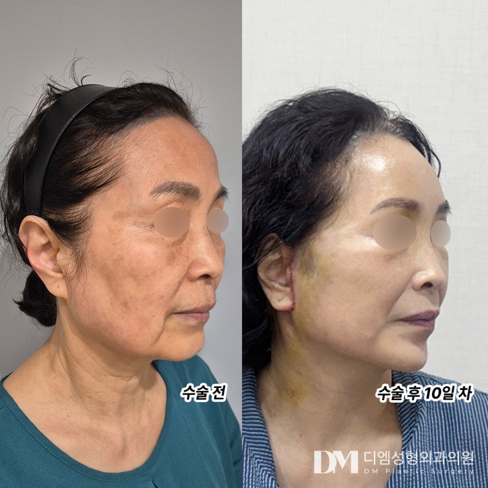 안면거상, 다시 젊었던 나로 ! 관련 이미지 6