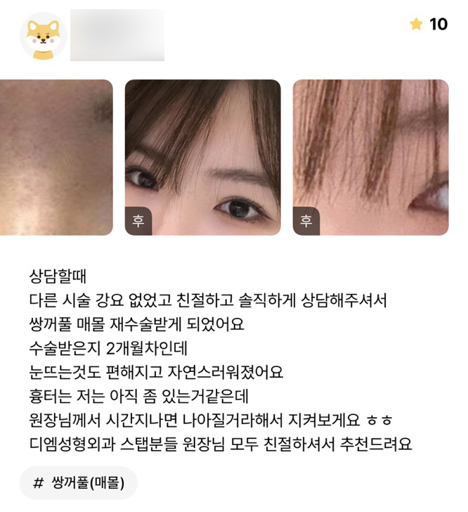 눈재수술 후기."눈 뜨는 것 도 편해지고 자연스러워졌어요!" 관련 이미지 1