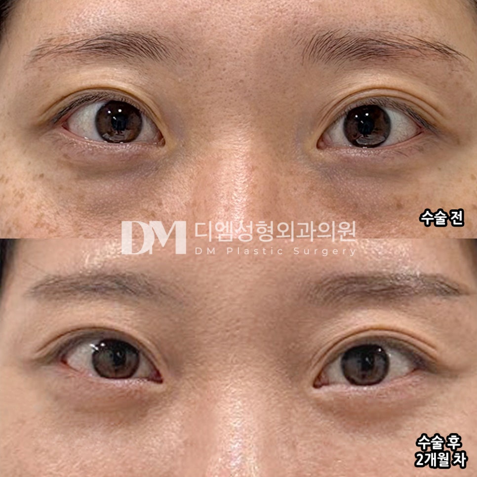 DM Lower Eyelid Fat Repositioning/Under-Eye Fat Grafting Surgery Review, &ldquo;I love how my overall impression improved naturally!&rdquo; image 2
