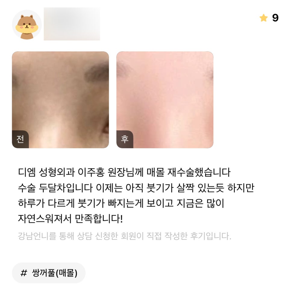 눈재수술 후기."지금은 많이 자연스러워져서 만족합니다!" 관련 이미지 1