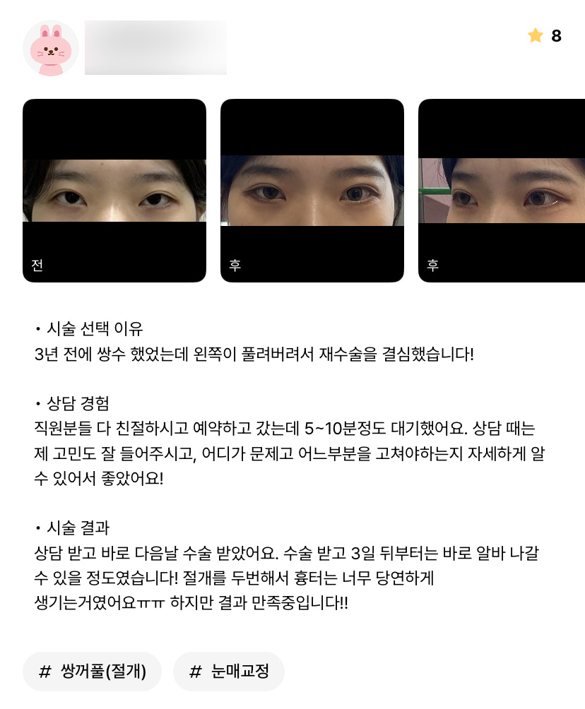 눈재수술 후기."자세한 상담이 좋았고 결과도 만족합니다!" 관련 이미지 1