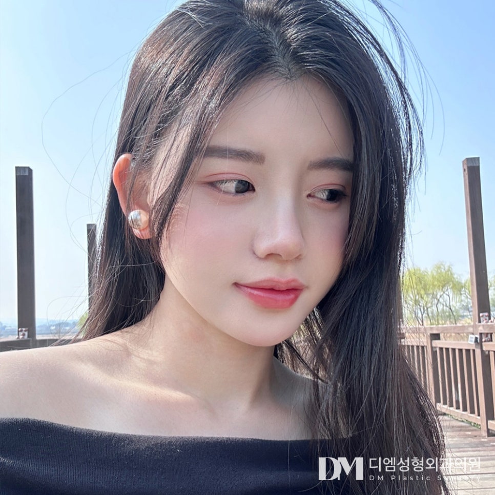 긴코,화살코 성형 코가 길고 끝이 처져 스트레스라면? 관련 이미지 1