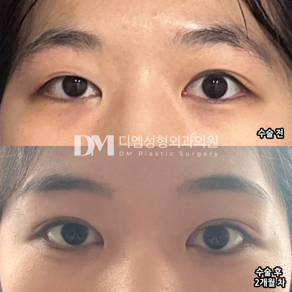 눈재수술 후기."빠른 회복으로 일상생활에 문제 없었어요!" 관련 이미지 2