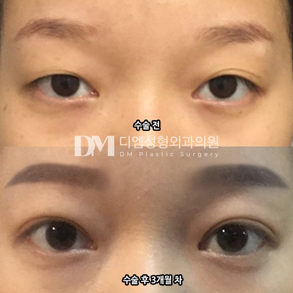 Review of Revision Eye Surgery. “The scar is gradually fading, and I’m satisfied!” image 2