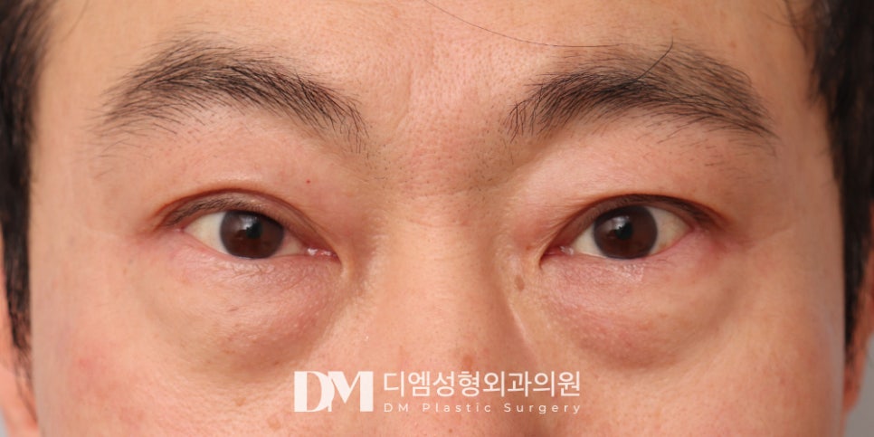 하안검, 눈 밑 노화 해결하고 동안되자 ! 관련 이미지 7