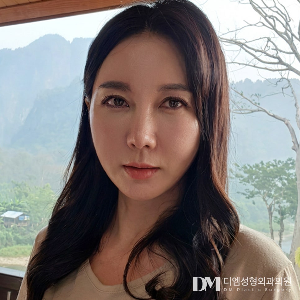 디엠 안면거상 전후사진, 탄력 잃고 늘어진 피부 되살리는 비결은? 관련 이미지 1