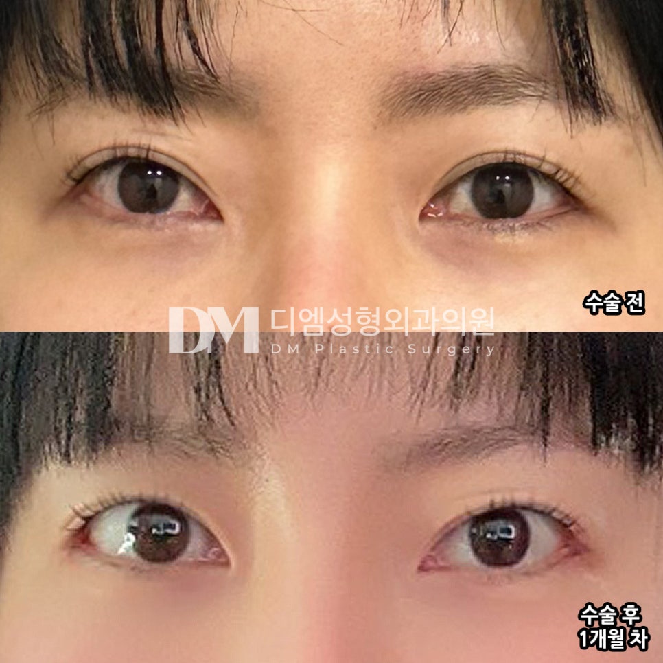 Review of lateral and lower canthoplasty. "I liked that the effect was visible right away!" image 2