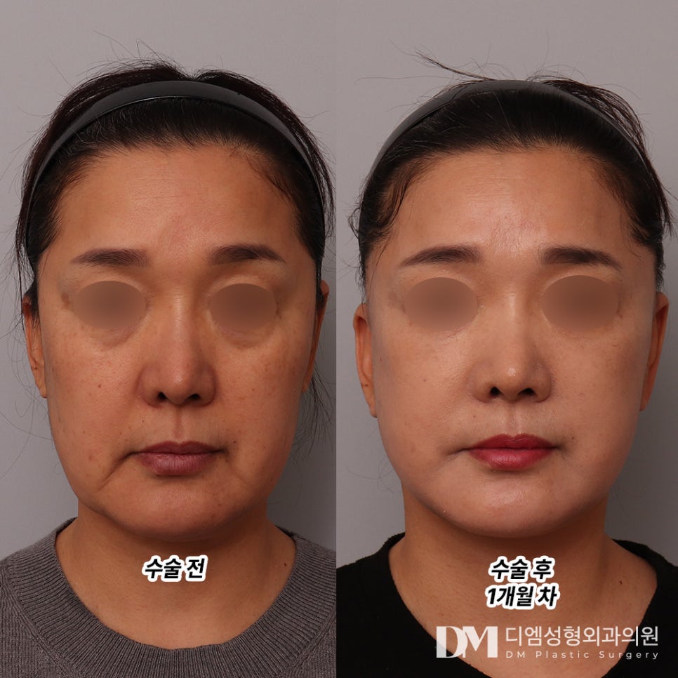 안면거상, 노화로 인한 피부처짐과 깊은 주름 개선 가능할까? 관련 이미지 6