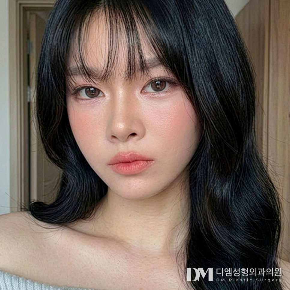 디엠 뒤밑트임 전후사진, 눈꼬리만 달라져도 인상이 바뀔까? 관련 이미지 3