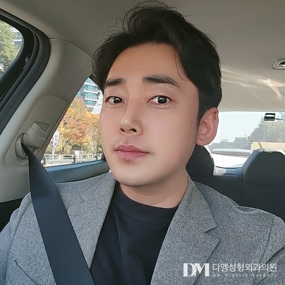 디엠 남자눈성형 전후사진, 부담스럽지 않게 또렷해지는 비결은? 관련 이미지 1