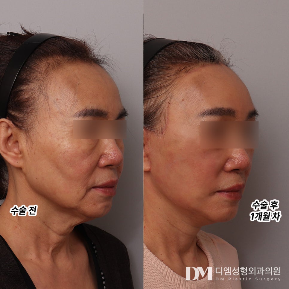 안면거상, 자연스럽게 동안으로 변신하기 ! 관련 이미지 6