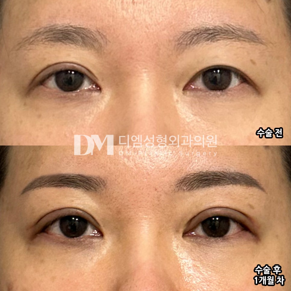 쌍꺼풀수술, 맞춤형 플랜으로 더욱 자연스럽게 관련 이미지 10