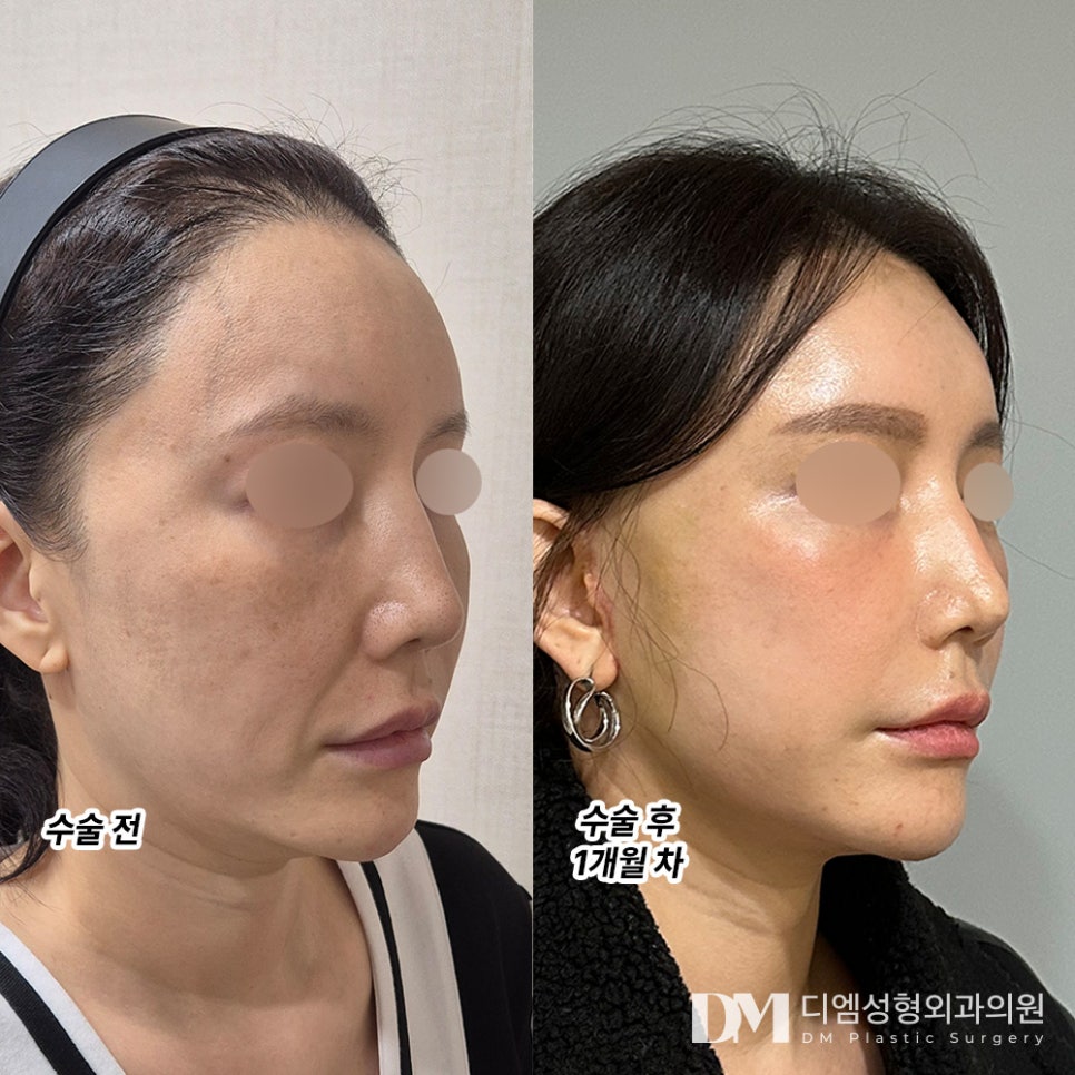 안면거상 후기."하루하루 자연스러워져서 거울 볼 맛 나요!" 관련 이미지 2